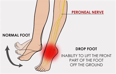 nerve causing foot drop